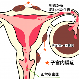 子宮内膜症 ジャスミンレディースクリニック
